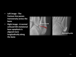 • Left image - The
fracture line passes
transversely across the
bone
• Right image - A normal
unfused 5th metatarsal
base apophysis is
aligned more
longitudinally along
the bone
103
 