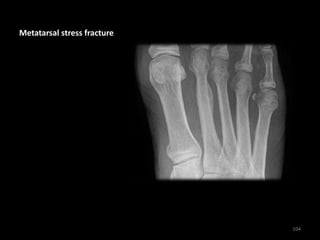Metatarsal stress fracture
104
 