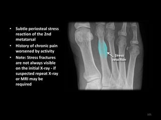 • Subtle periosteal stress
reaction of the 2nd
metatarsal
• History of chronic pain
worsened by activity
• Note: Stress fractures
are not always visible
on the initial X-ray - if
suspected repeat X-ray
or MRI may be
required
105
 