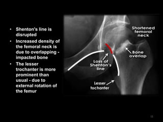 • Shenton's line is
disrupted
• Increased density of
the femoral neck is
due to overlapping -
impacted bone
• The lesser
trochanter is more
prominent than
usual - due to
external rotation of
the femur
11
 