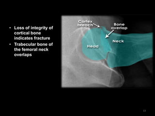 • Loss of integrity of
cortical bone
indicates fracture
• Trabecular bone of
the femoral neck
overlaps
13
 