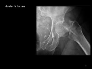 Garden IV fracture
16
 