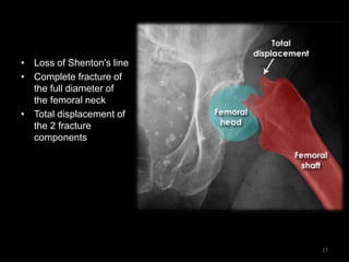 • Loss of Shenton's line
• Complete fracture of
the full diameter of
the femoral neck
• Total displacement of
the 2 fracture
components
17
 