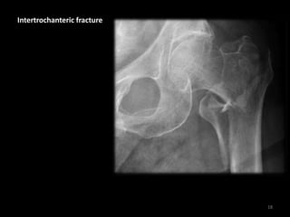 Intertrochanteric fracture
18
 