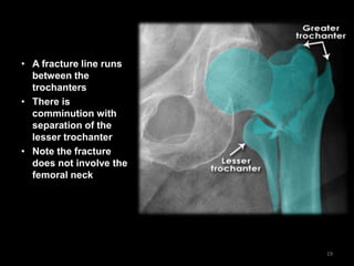 • A fracture line runs
between the
trochanters
• There is
comminution with
separation of the
lesser trochanter
• Note the fracture
does not involve the
femoral neck
19
 