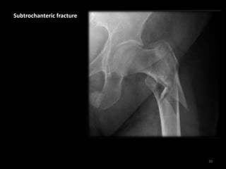 Subtrochanteric fracture
20
 