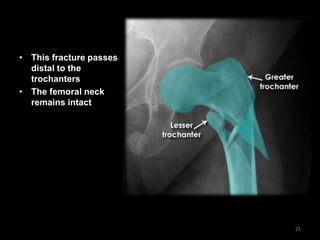 • This fracture passes
distal to the
trochanters
• The femoral neck
remains intact
21
 