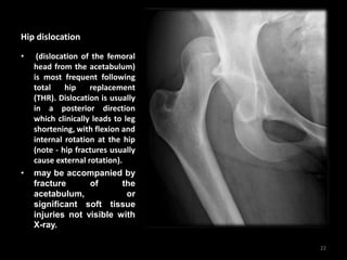 Hip dislocation
• (dislocation of the femoral
head from the acetabulum)
is most frequent following
total hip replacement
(THR). Dislocation is usually
in a posterior direction
which clinically leads to leg
shortening, with flexion and
internal rotation at the hip
(note - hip fractures usually
cause external rotation).
• may be accompanied by
fracture of the
acetabulum, or
significant soft tissue
injuries not visible with
X-ray.
22
 