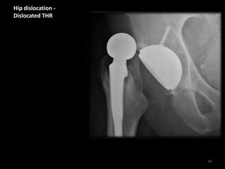 Hip dislocation -
Dislocated THR
24
 
