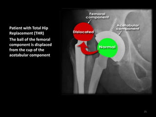 Patient with Total Hip
Replacement (THR)
The ball of the femoral
component is displaced
from the cup of the
acetabular component
25
 