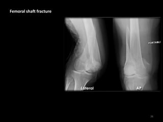 Femoral shaft fracture
26
 