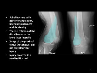 • Spiral fracture with
posterior angulation,
lateral displacement
and shortening
• There is rotation of the
distal femur so the
knee faces laterally
• X-rays of the proximal
femur (not shown) did
not reveal further
injury
• Injury occurred in a
road traffic crash
27
 