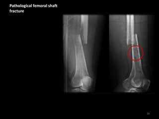 Pathological femoral shaft
fracture
28
 