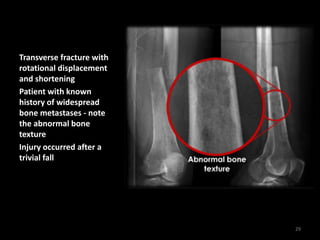 Transverse fracture with
rotational displacement
and shortening
Patient with known
history of widespread
bone metastases - note
the abnormal bone
texture
Injury occurred after a
trivial fall
29
 