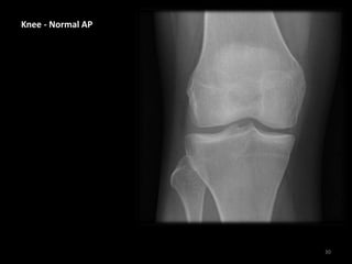 Knee - Normal AP
30
 