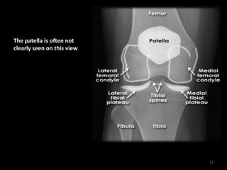 The patella is often not
clearly seen on this view
31
 