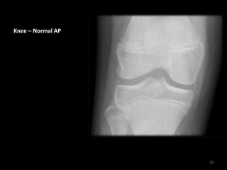 Knee – Normal AP
32
 
