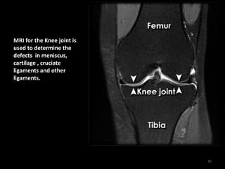 MRI for the Knee joint is
used to determine the
defects in meniscus,
cartilage , cruciate
ligaments and other
ligaments.
35
 