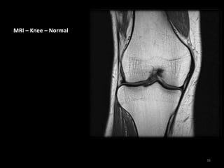 MRI – Knee – Normal
36
 