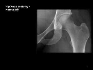 Hip X-ray anatomy -
Normal AP
4
 