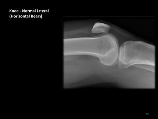 Knee - Normal Lateral
(Horizontal Beam)
40
 