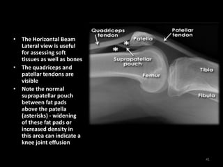 • The Horizontal Beam
Lateral view is useful
for assessing soft
tissues as well as bones
• The quadriceps and
patellar tendons are
visible
• Note the normal
suprapatellar pouch
between fat pads
above the patella
(asterisks) - widening
of these fat pads or
increased density in
this area can indicate a
knee joint effusion
41
 