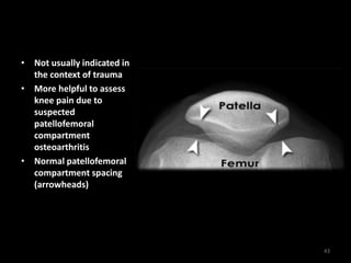 • Not usually indicated in
the context of trauma
• More helpful to assess
knee pain due to
suspected
patellofemoral
compartment
osteoarthritis
• Normal patellofemoral
compartment spacing
(arrowheads)
43
 