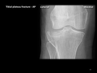 Tibial plateau fracture - AP
44
 