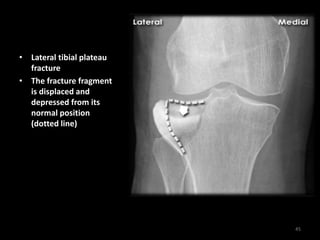 • Lateral tibial plateau
fracture
• The fracture fragment
is displaced and
depressed from its
normal position
(dotted line)
45
 