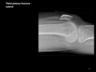 Tibial plateau fracture -
Lateral
46
 