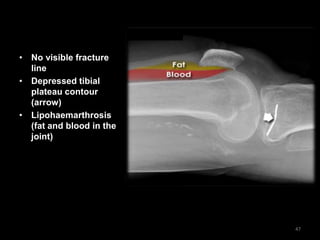 • No visible fracture
line
• Depressed tibial
plateau contour
(arrow)
• Lipohaemarthrosis
(fat and blood in the
joint)
47
 