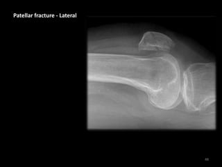 Patellar fracture - Lateral
48
 