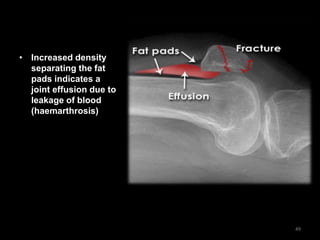 • Increased density
separating the fat
pads indicates a
joint effusion due to
leakage of blood
(haemarthrosis)
49
 