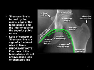 • Shenton's line is
formed by the
medial edge of the
femoral neck and
the inferior edge of
the superior pubic
ramus
• Loss of contour of
Shenton's line is a
sign of a fractured
neck of femur
• IMPORTANT NOTE:
Fractures of the
femoral neck do not
always cause loss
of Shenton's line
5
 