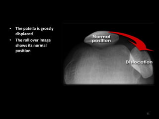• The patella is grossly
displaced
• The roll over image
shows its normal
position
51
 