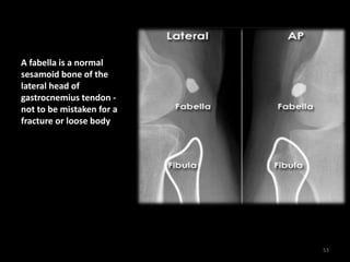 A fabella is a normal
sesamoid bone of the
lateral head of
gastrocnemius tendon -
not to be mistaken for a
fracture or loose body
53
 