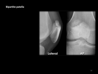 Bipartite patella
54
 