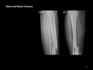 Tibial and fibular fracture
56
 