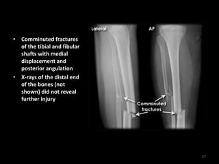 • Comminuted fractures
of the tibial and fibular
shafts with medial
displacement and
posterior angulation
• X-rays of the distal end
of the bones (not
shown) did not reveal
further injury
57
 