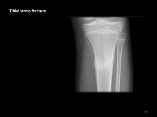 Tibial stress fracture
58
 