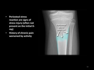 • Periosteal stress
reaction are signs of
stress injury (often not
present on the initial X-
ray)
• History of chronic pain
worsened by activity
59
 