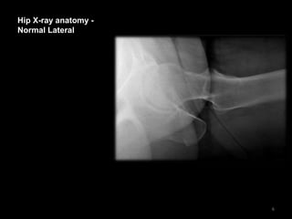Hip X-ray anatomy -
Normal Lateral
6
 