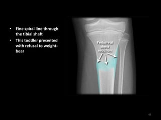 • Fine spiral line through
the tibial shaft
• This toddler presented
with refusal to weight-
bear
61
 