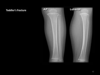Toddler's fracture
62
 