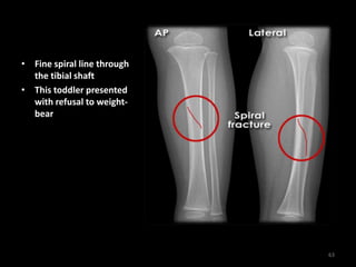 • Fine spiral line through
the tibial shaft
• This toddler presented
with refusal to weight-
bear
63
 