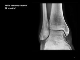 Ankle anatomy - Normal
AP 'mortise'
64
 