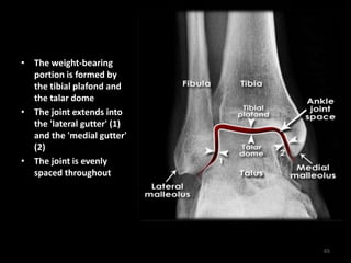 • The weight-bearing
portion is formed by
the tibial plafond and
the talar dome
• The joint extends into
the 'lateral gutter' (1)
and the 'medial gutter'
(2)
• The joint is evenly
spaced throughout
65
 