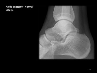 Ankle anatomy - Normal
Lateral
66
 