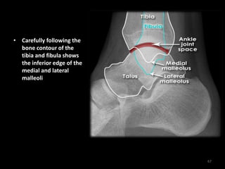 • Carefully following the
bone contour of the
tibia and fibula shows
the inferior edge of the
medial and lateral
malleoli
67
 