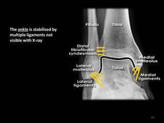 The ankle is stabilised by
multiple ligaments not
visible with X-ray
69
 